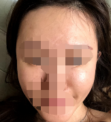 脂肪在脸上存活得很好 正如我所希望的那样-41282