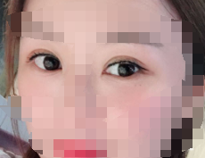 做了双眼皮变化真大 家里亲戚都夸我越来越美了-41827