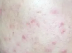 痘印痘坑难消除 这些项目总有一个适合你