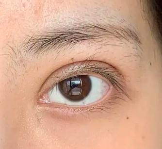 双眼皮术后出现难看的“肉条”该如何修复