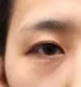 泪沟显老怎么办 如何快速改善泪沟