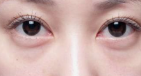 眼部松弛下垂应该选择哪种手术方式来改善 双眼皮还是提眉