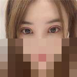 做完双眼皮 好多人都夸好看-43087