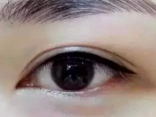 看到自己手术后的效果是那么自然和美丽