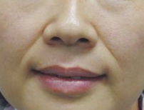 3.8妇女节变美无需等待 光子嫩肤是值得做的医美项目