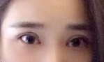 很满意现在的双眼皮-43802