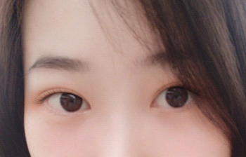 很满意现在的双眼皮 很合适