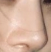 这次玻尿酸注射隆鼻的经历虽然有些小插曲 但结果却是非常满意的