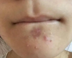 变美也要做好功课 5种常用面部注射填充剂大盘点