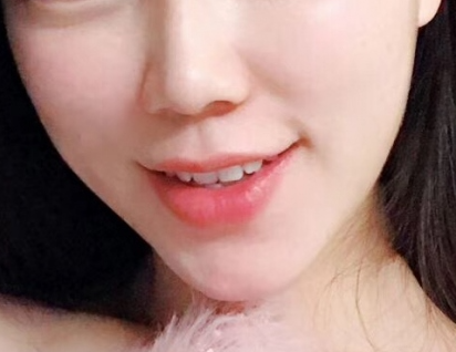 消肿很快 很自然现在