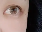 用玻尿酸填充完泪沟了 精神状态看着总算有所改变了-46811