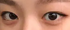 割双眼皮是通过改变眼部缺陷来使眼睛变得漂亮