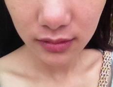 凹陷脸显得面部衰老 如何做好抗衰工作呢