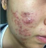 青春期的烦恼 如何有效应对反复出现的痘痘