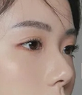 假体隆鼻术后伤口不愈合怎么办 会发生感染吗