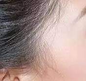 颜值提升小秘诀 玻尿酸丰太阳穴一般需要多少量
