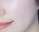 做完光子嫩肤后 感觉真的很不错