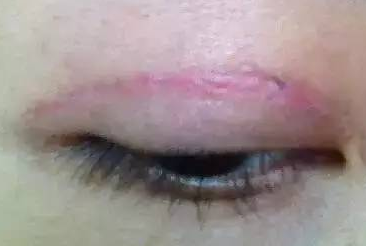 双眼皮修复做了一次又一次 些坑你都中了吗  