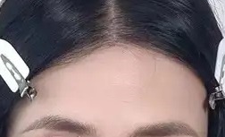 植发不仅改变了我的外貌 更重要的是，它让我学会了勇敢坚持和自信-49102