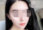 因为做了发际线种植 拯救了我的高额头找回颜值
