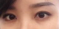 如今好眼袋去掉了 我也是小仙女一枚