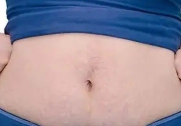 产后腹部皮肤松弛 怎么可以让产后妈妈恢复自信的身材