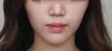 皮肤细腻法令纹变浅了 比做填充之前年轻呀