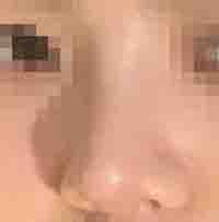 现在的鼻子精致又立体 看起来非常的自然-49282