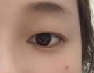 因单眼皮自卑的姑娘 开启了拥有双眼皮之旅