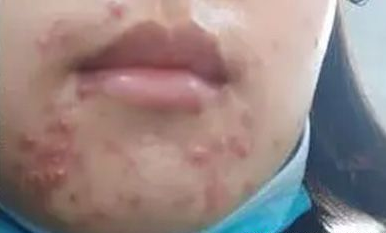 战“痘”全攻略！粉刺痘痘退退退，还你光滑美肌？
