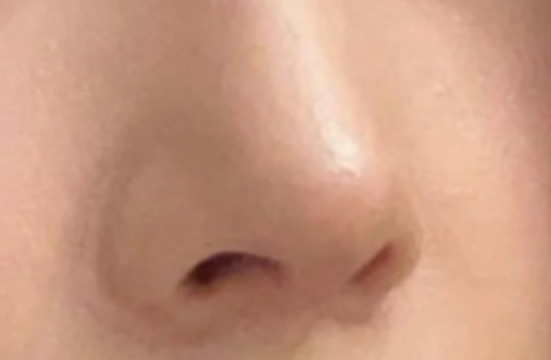从困扰到主动 还原自己鼻子变精致的过程-49406