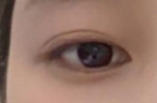 因单眼皮被说没有神采 做了双眼皮身边朋友惊呆了-49407