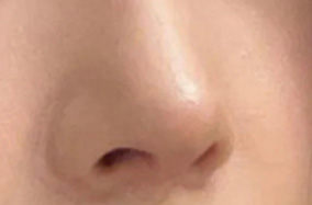 从困扰到主动 还原自己鼻子变精致的过程