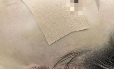 面部松弛下垂显老态？专家教你4招：吃对+防晒+医美，重拾紧致少女肌！