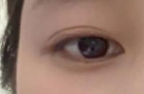 因单眼皮被说没有神采 做了双眼皮身边朋友惊呆了