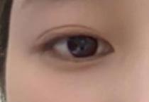 美丽双眼打造指南：做双眼皮手术可能会面临的一些问题