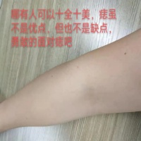 激光祛痣，我亲身体验的结果！