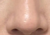 注射隆鼻：科学改善鼻型