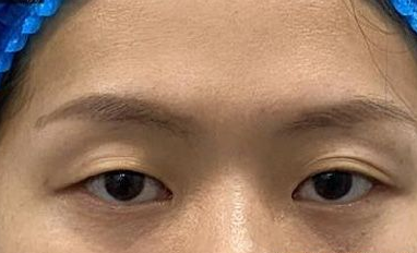 眼眸藏情韵，玻尿酸丰眼窝解锁“睛”彩密码