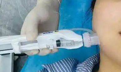 水光与超皮秒/皮秒的完美融合：黄金搭配指南