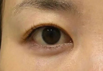 审美多元化 如何消除眼袋下垂 