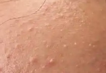 点阵激光去痘坑：光滑肌肤是科学与耐心的结晶