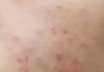 针对油痘肌的护肤需求 