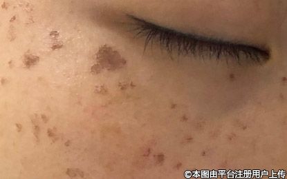 脸上长雀斑，怎么办？