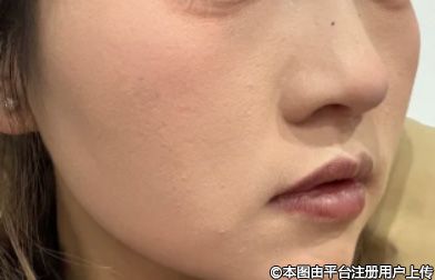 鼻部整形失败后，“小白鼠”却不知道，修复是非常难的