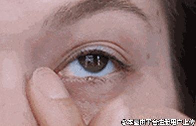 自体脂肪填充泪沟的神奇之处