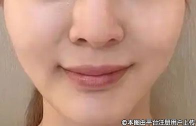 膨体隆鼻怎么样？