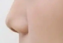 硅胶假体隆鼻：科学塑美背后的理性选择