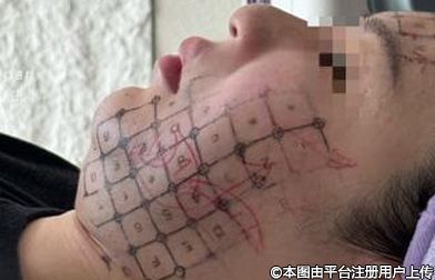 热玛吉作用原理深度解析！