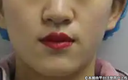 自体脂肪填充术后热/冷敷的医学解析：为何需严格避免？
